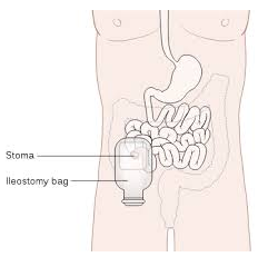 WHAT IS OSTOMY?