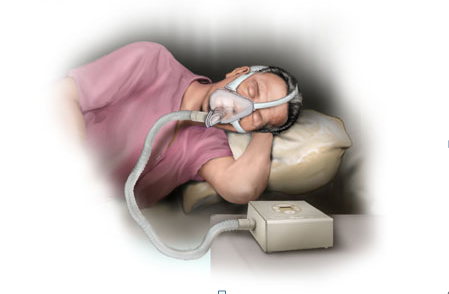  CPAP or BiPAP: Which Is Right for You?