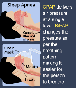  CPAP or BiPAP: Which Is Right for You? 