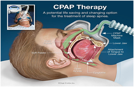 What is CPAP Machine