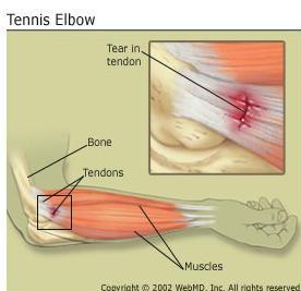  Game, Set, and Match!! Dealing with Tennis Elbow 