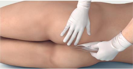 Mepilex_border_sacrum_application