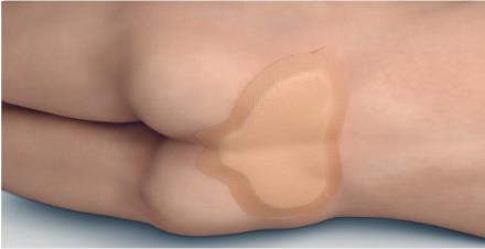 Mepilex_border_sacrum_application