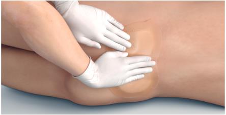 Mepilex_border_sacrum_application