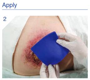 Hydrofera_Classic_Dressing_Application