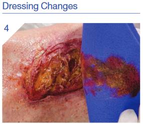 Hydrofera_Classic_Dressing_Application