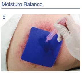 Hydrofera_Classic_Dressing_Application