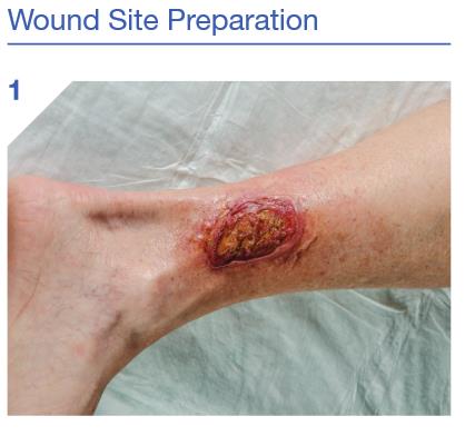 Hydrofera_blue_ready_application