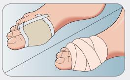 Mepilex_lite_Application