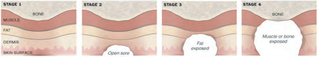 Stages of Ulcers
