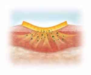  Medline TheraHoney Gel Honey Dressing 