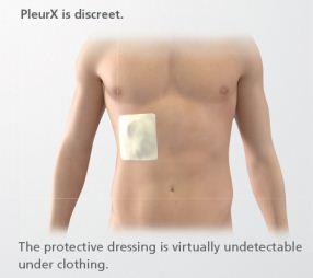 How does the PleurX system work