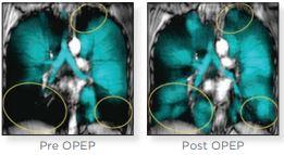 Before and After using OPEP therapy for COPD