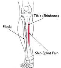 How To Treat Shin Splints Quickly Health Products For You