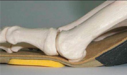 Buy Vasyli Dananberg Fist Ray Orthotic [Custom Insoles]