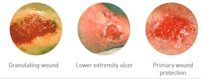 Mepilex_border_lite_indications
