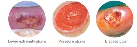 Mepilex_foam_dressing_areas_of_use
