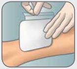 Mepilex_foam_dressing_application