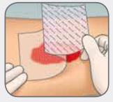 Mepitel_One_Dressing_Application