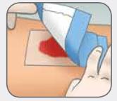 Mepitel_One_Dressing_Application