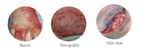 Mepitel_One_Dressing_Indications