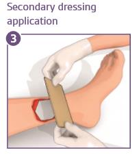 Promogran_Prisma_Dressing_Application