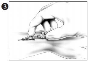 How to insert BD Insyte Autoguard Shielded IV Catheter?