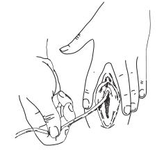 Female Intermittent Self-Catheterization