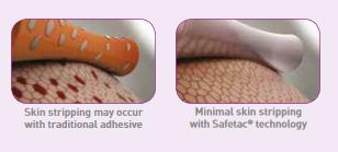 Mepilex_border_ag_Dressing
